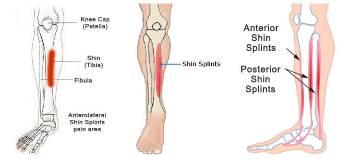 Underpronation on sale shin splints